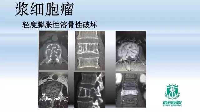【PPT】常见椎体单发溶骨性病变