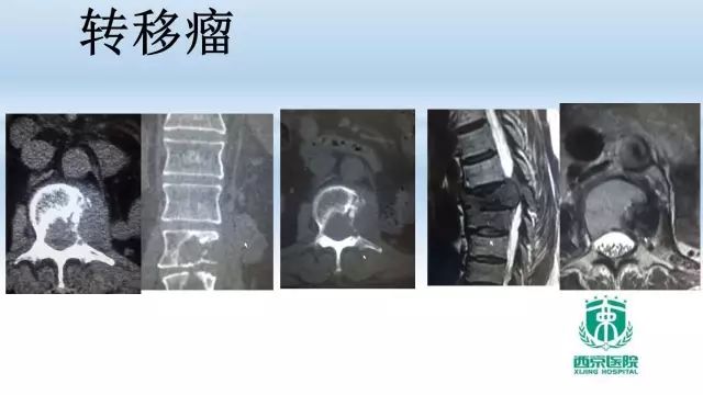 【PPT】常见椎体单发溶骨性病变