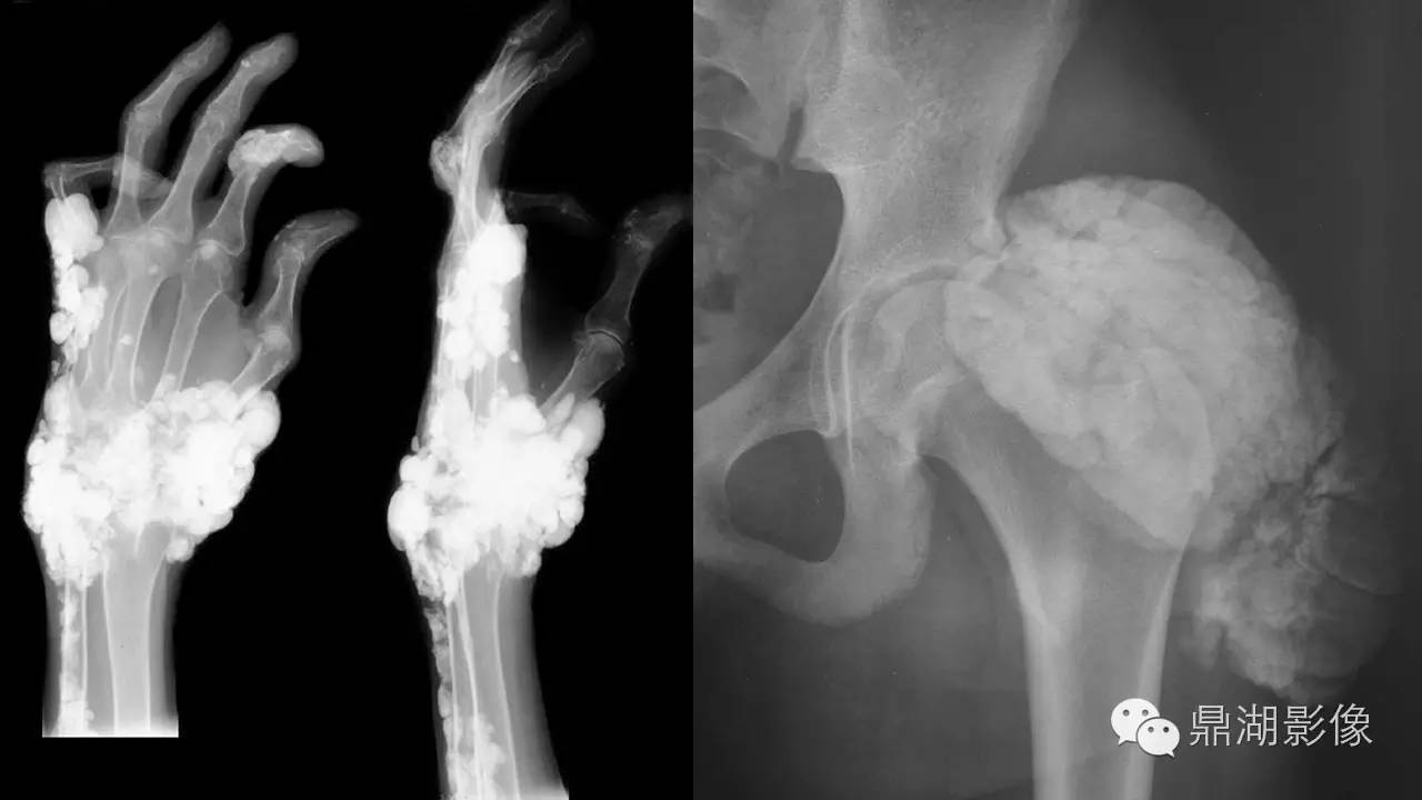 【PPT】软组织钙化(的鉴别)