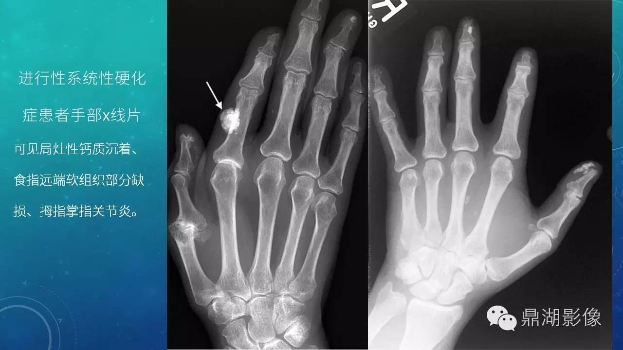 【PPT】软组织钙化(的鉴别)