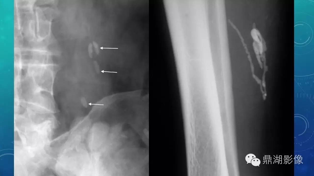 【PPT】软组织钙化(的鉴别)