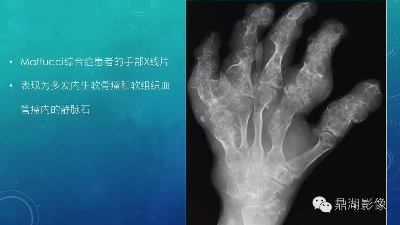【PPT】软组织钙化(的鉴别)
