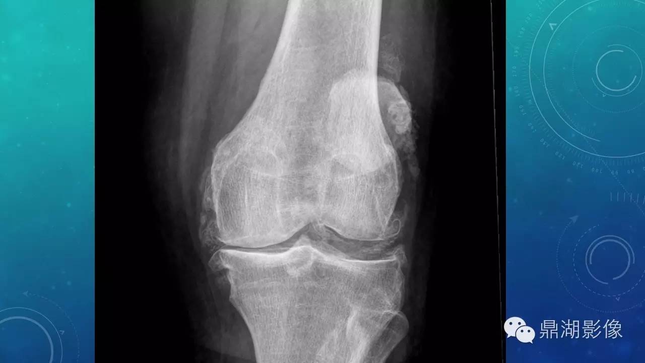 【PPT】软组织钙化(的鉴别)