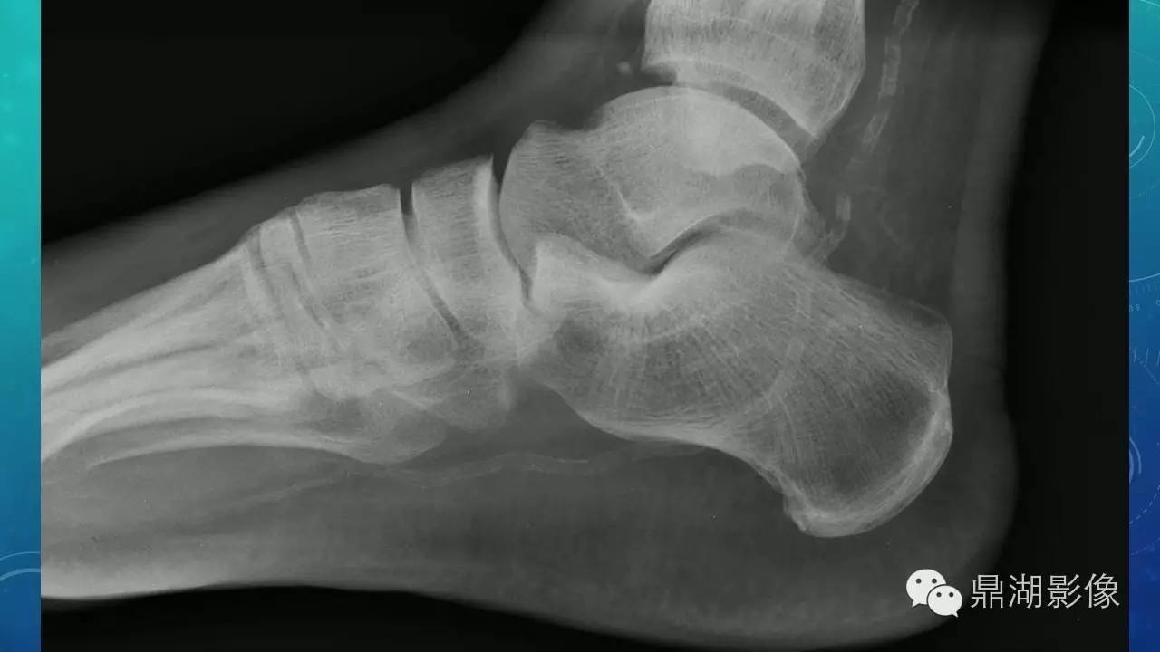 【PPT】软组织钙化(的鉴别)