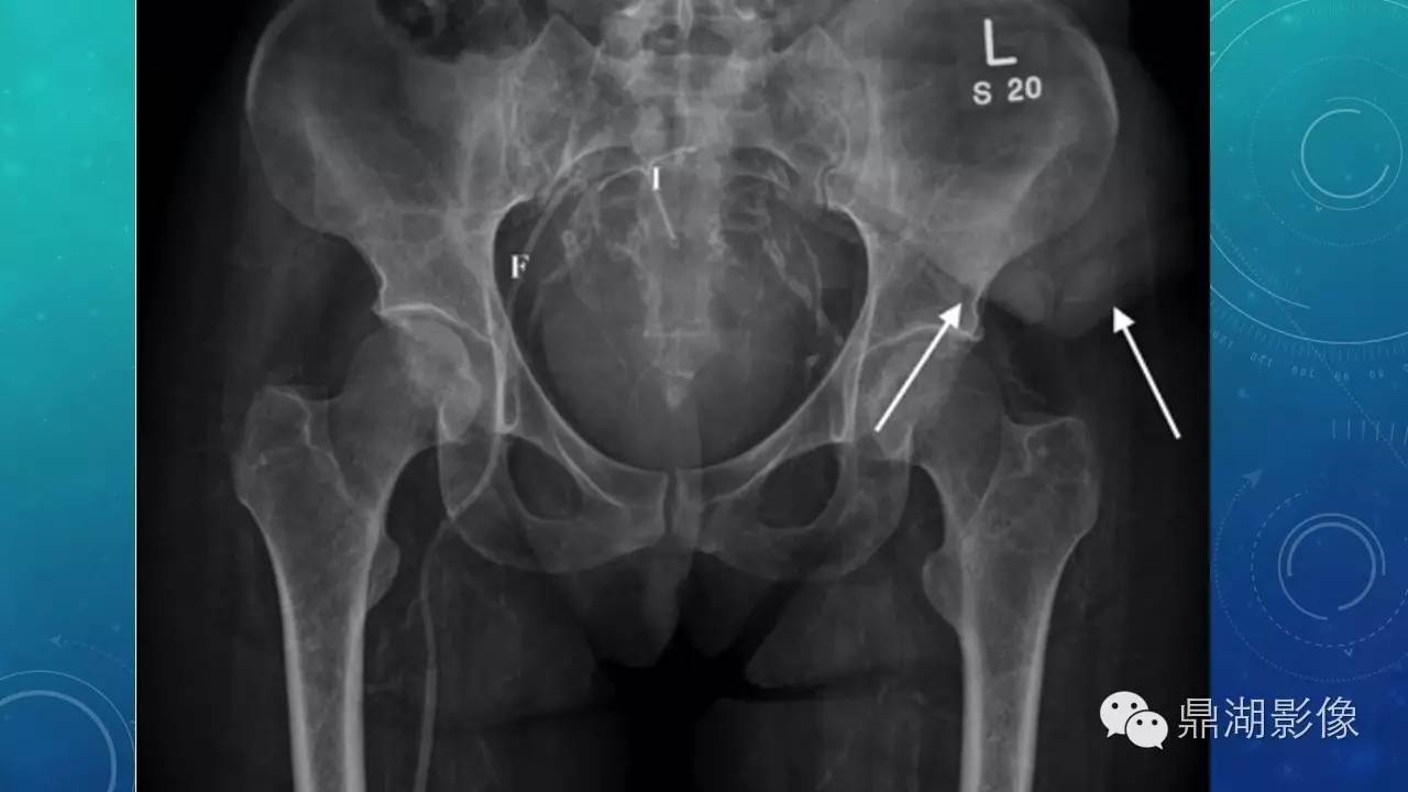 【PPT】软组织钙化(的鉴别)