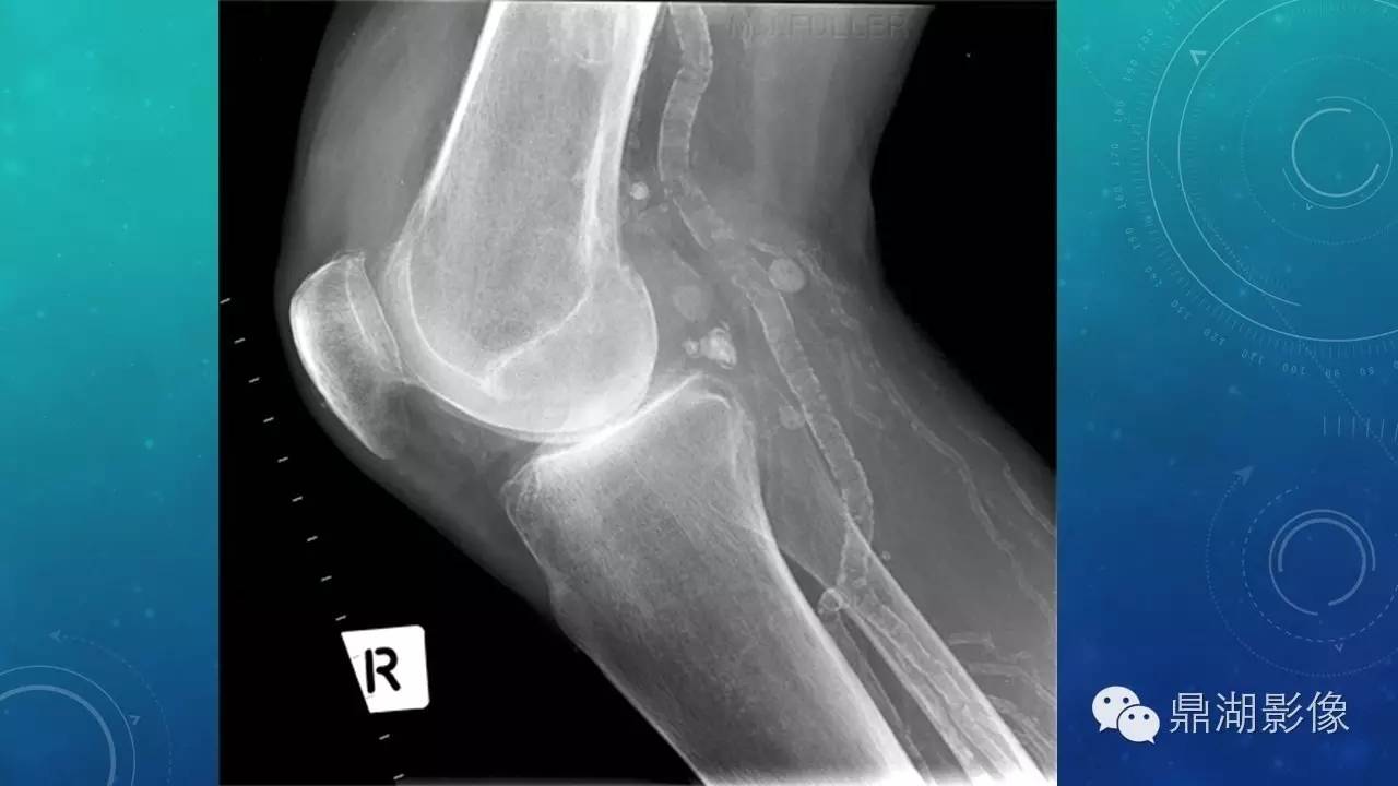 【PPT】软组织钙化(的鉴别)