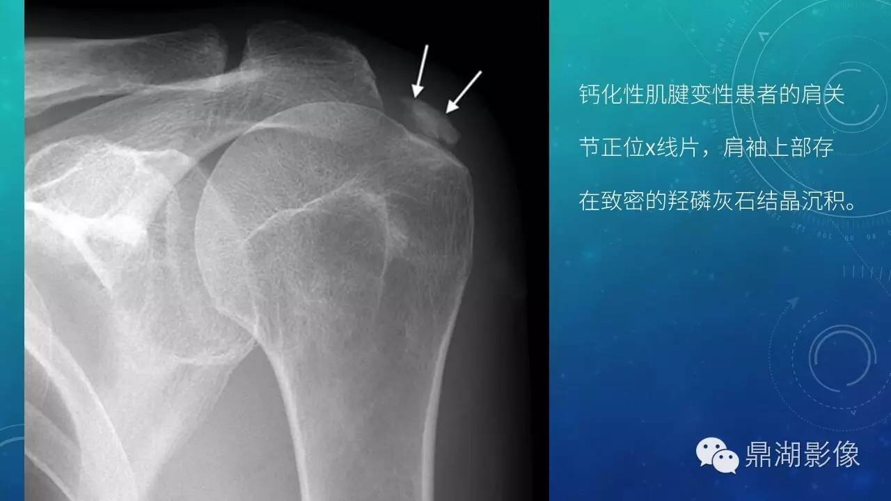 【PPT】软组织钙化(的鉴别)