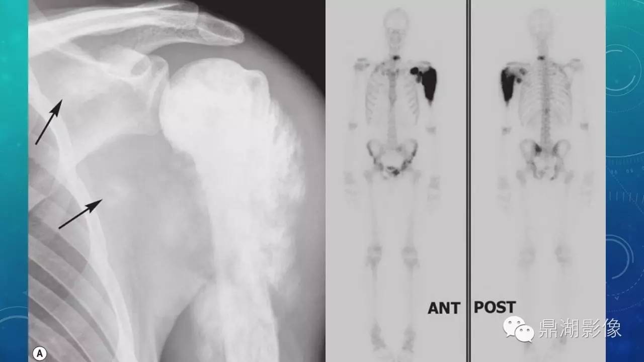 【PPT】软组织钙化(的鉴别)