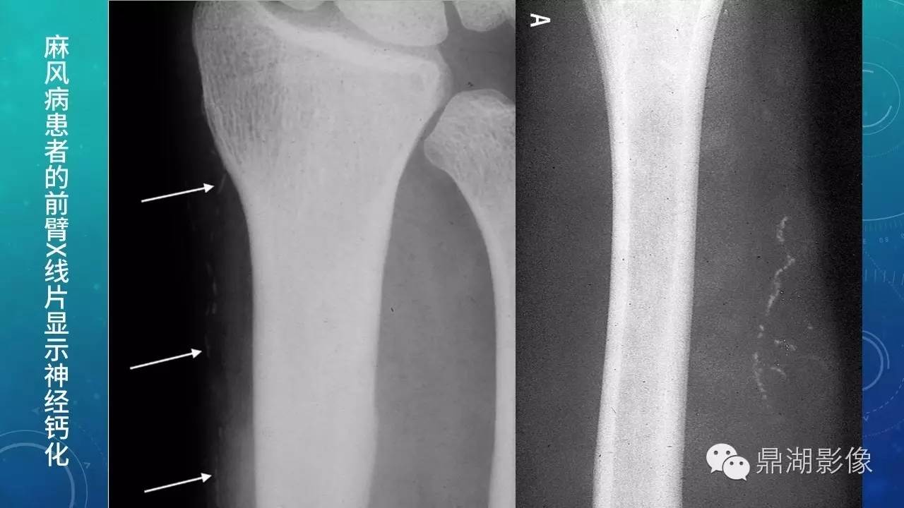 【PPT】软组织钙化(的鉴别)