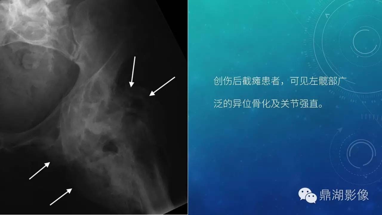 【PPT】软组织钙化(的鉴别)