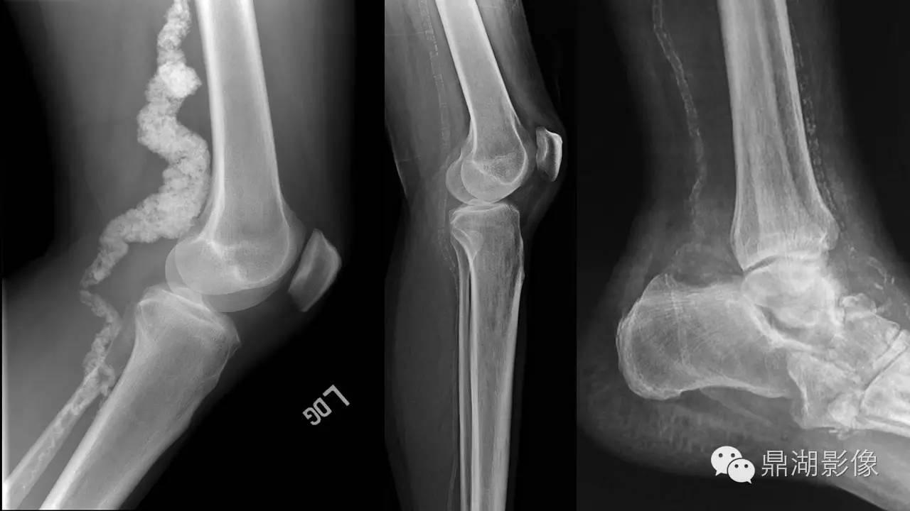 【PPT】软组织钙化(的鉴别)