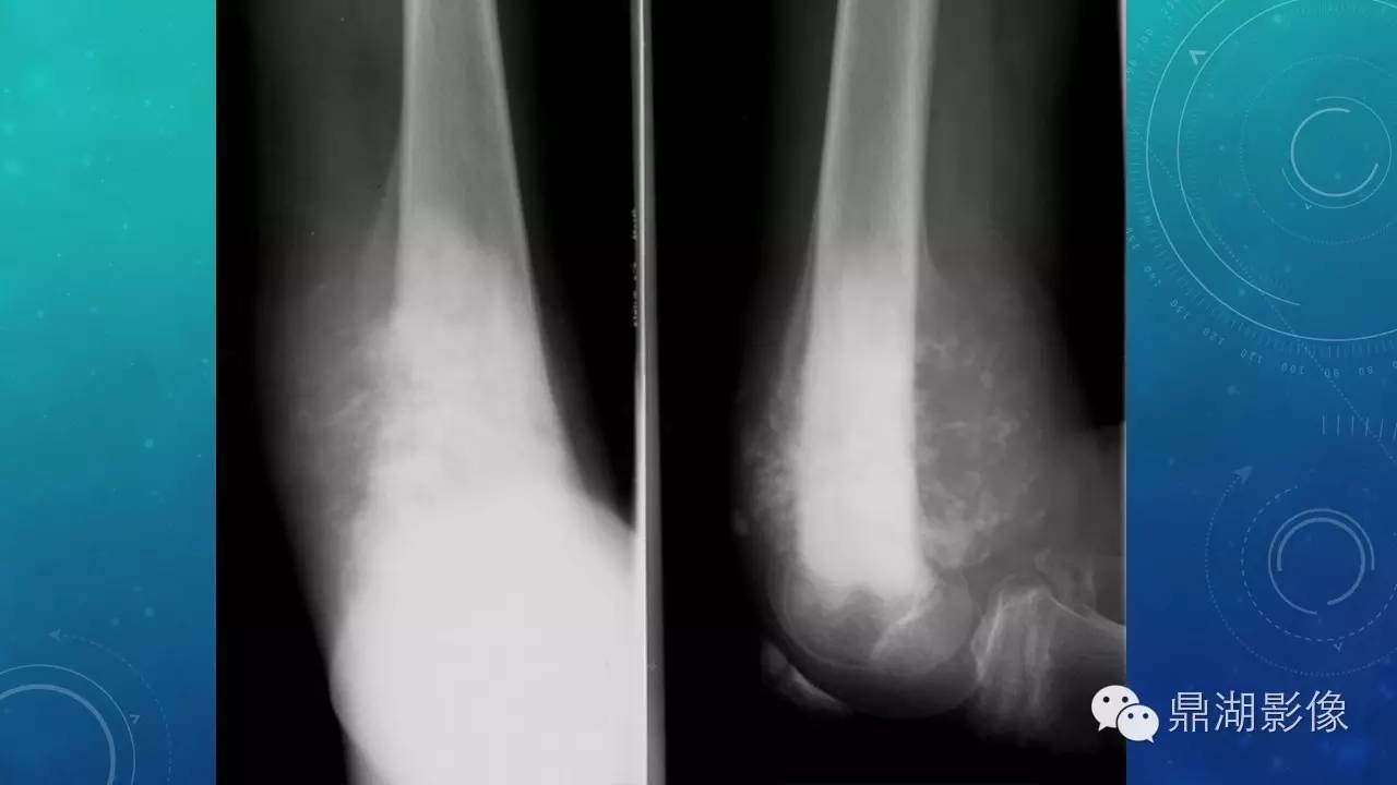 【PPT】软组织钙化(的鉴别)