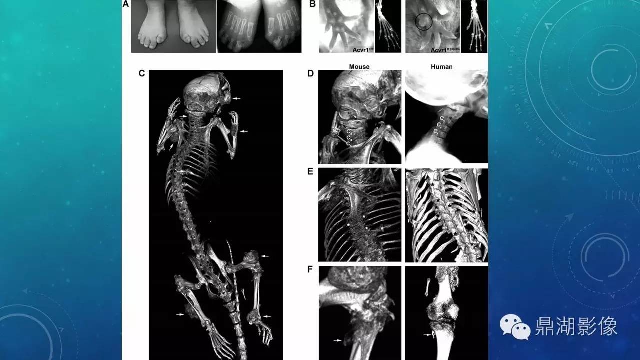 【PPT】软组织钙化(的鉴别)