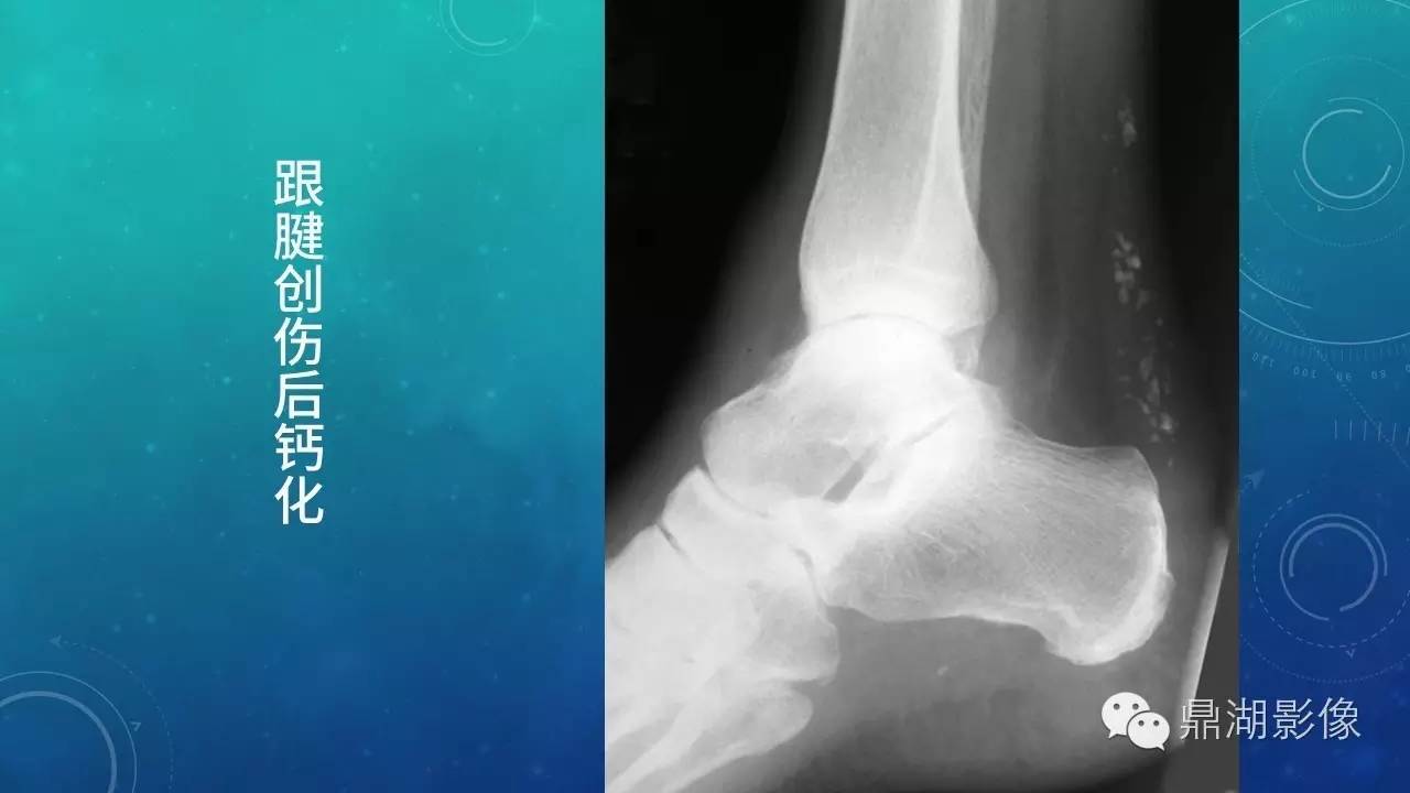 【PPT】软组织钙化(的鉴别)