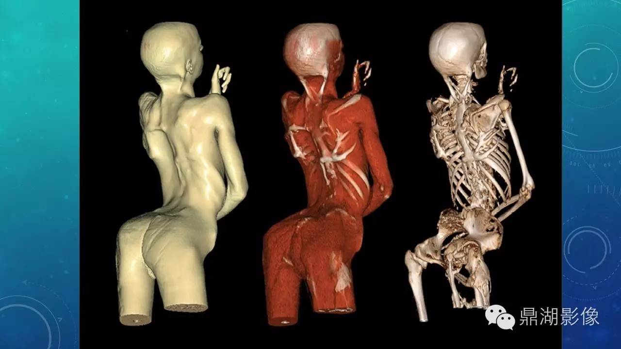 【PPT】软组织钙化(的鉴别)