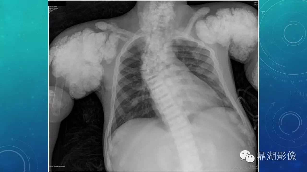 【PPT】软组织钙化(的鉴别)