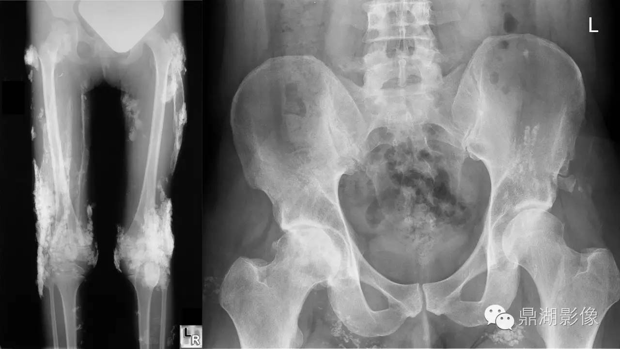 【PPT】软组织钙化(的鉴别)