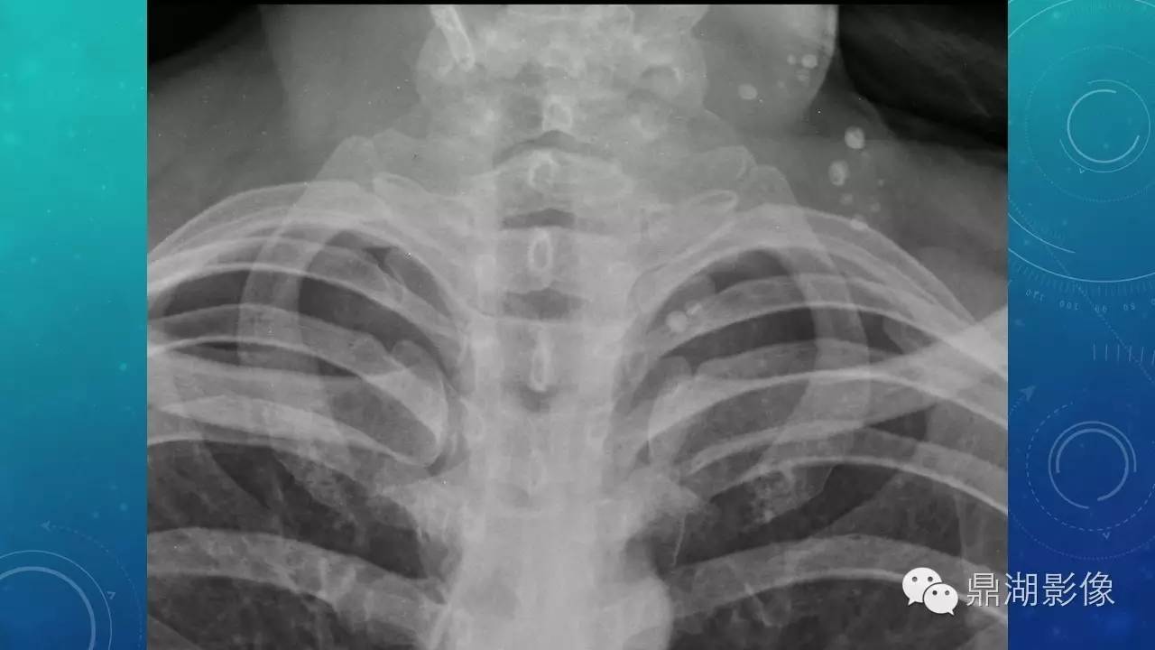 【PPT】软组织钙化(的鉴别)