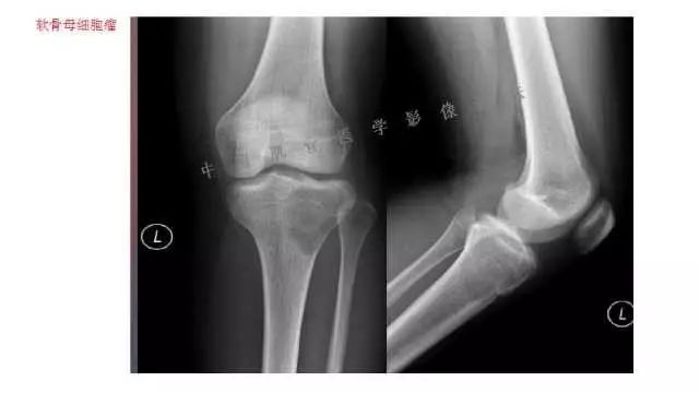 【PPT】常见骨骼病变的诊断与鉴别诊断