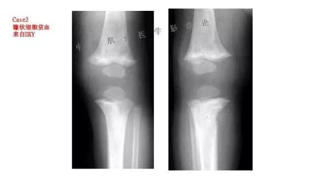 【PPT】常见骨骼病变的诊断与鉴别诊断