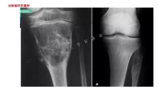 【PPT】常见骨骼病变的诊断与鉴别诊断