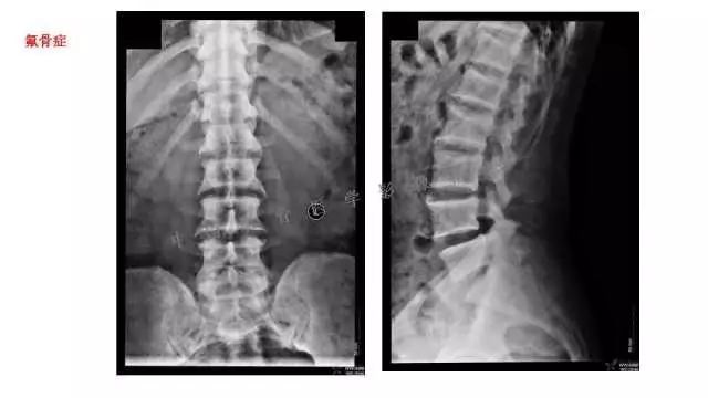 【PPT】常见骨骼病变的诊断与鉴别诊断