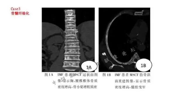 【PPT】常见骨骼病变的诊断与鉴别诊断
