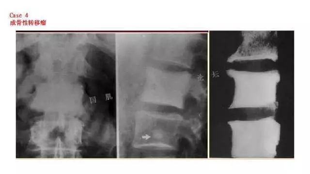 【PPT】常见骨骼病变的诊断与鉴别诊断
