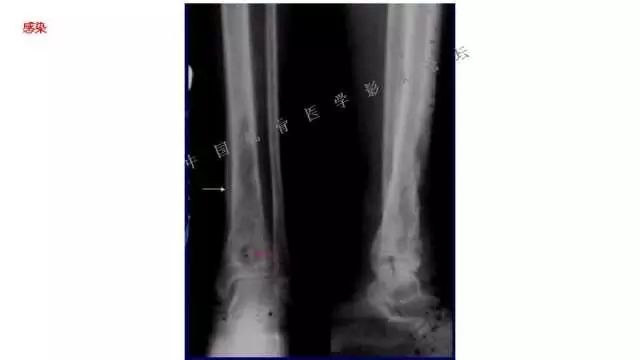 【PPT】常见骨骼病变的诊断与鉴别诊断