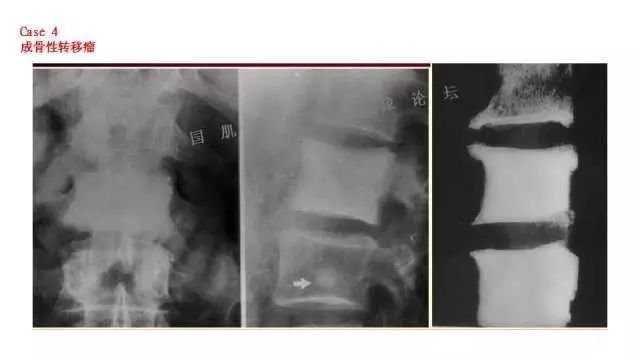 【PPT】常见骨骼病变的诊断与鉴别诊断