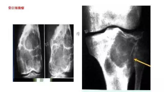 【PPT】常见骨骼病变的诊断与鉴别诊断