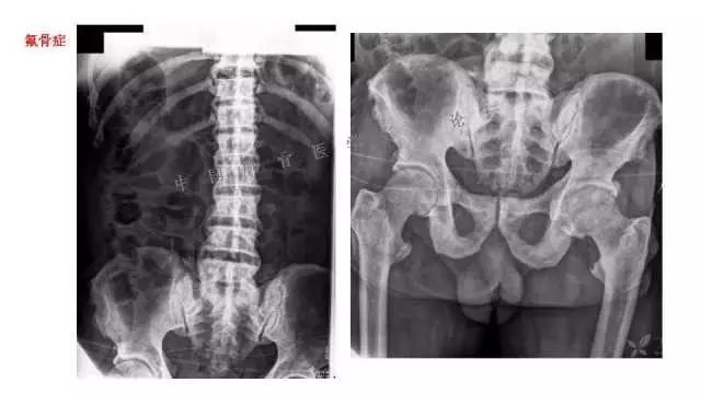 【PPT】常见骨骼病变的诊断与鉴别诊断