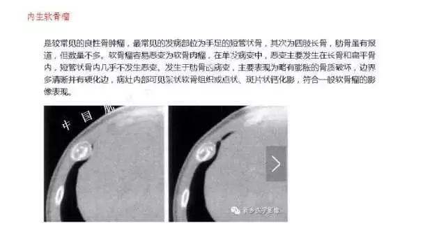 【PPT】常见骨骼病变的诊断与鉴别诊断