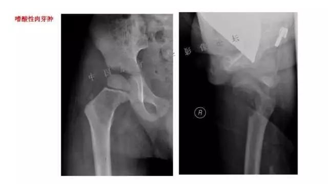 【PPT】常见骨骼病变的诊断与鉴别诊断