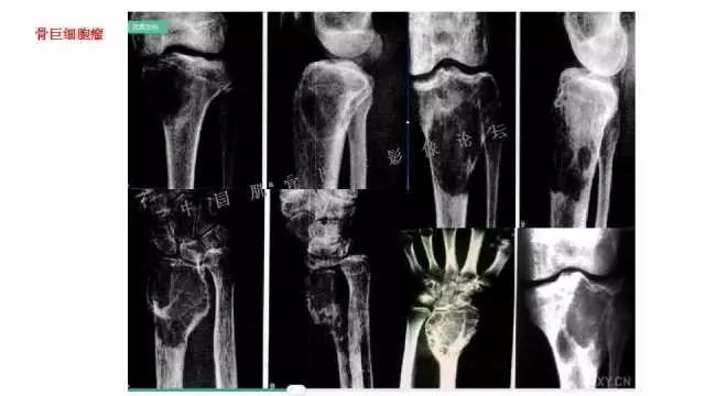【PPT】常见骨骼病变的诊断与鉴别诊断