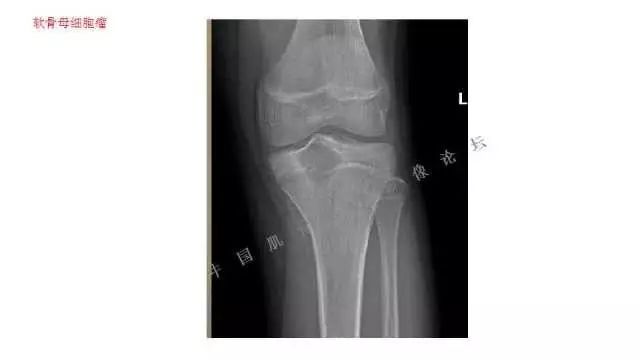 【PPT】常见骨骼病变的诊断与鉴别诊断