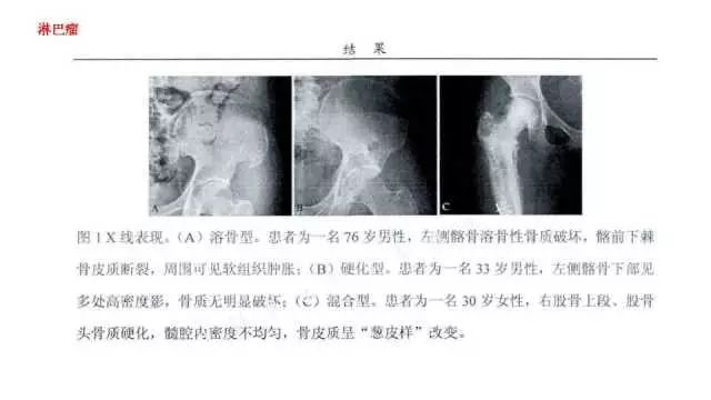【PPT】常见骨骼病变的诊断与鉴别诊断
