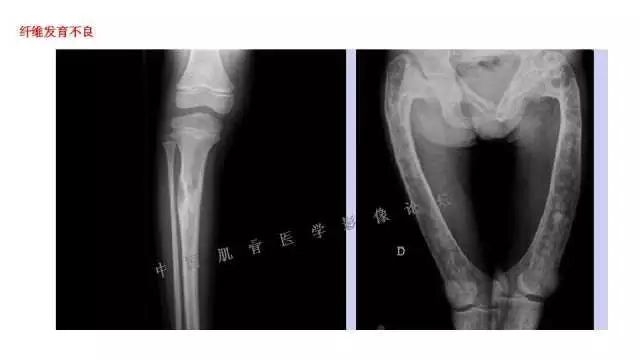 【PPT】常见骨骼病变的诊断与鉴别诊断