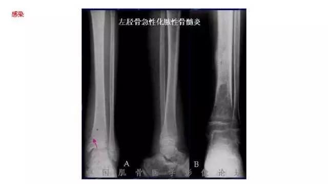 【PPT】常见骨骼病变的诊断与鉴别诊断