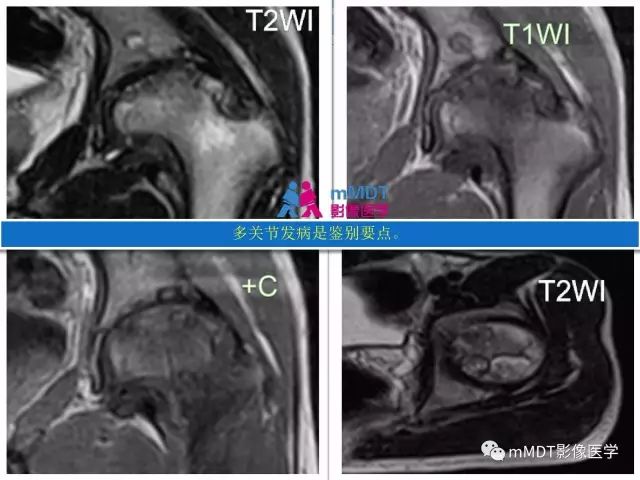 【PPT】膝关节色素沉着绒毛结节性滑膜炎影像表现PVNS