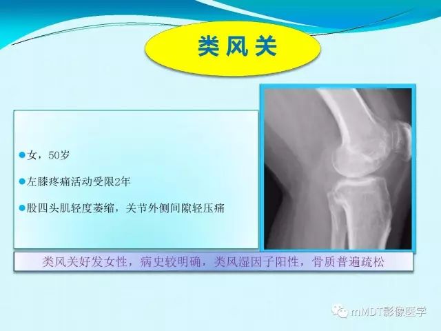 【PPT】膝关节色素沉着绒毛结节性滑膜炎影像表现PVNS
