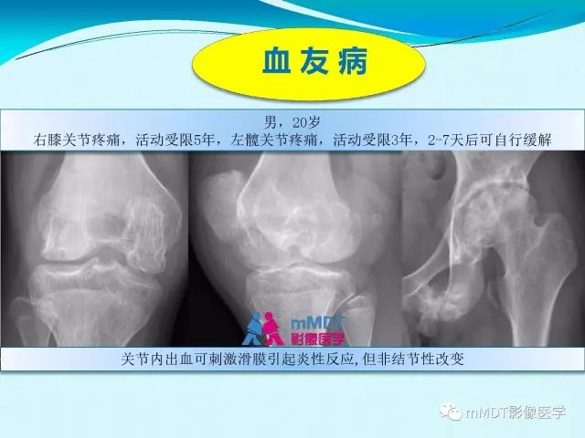 【PPT】膝关节色素沉着绒毛结节性滑膜炎影像表现PVNS