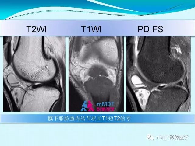 【PPT】膝关节色素沉着绒毛结节性滑膜炎影像表现PVNS