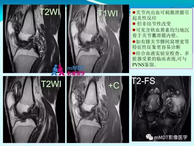 【PPT】膝关节色素沉着绒毛结节性滑膜炎影像表现PVNS