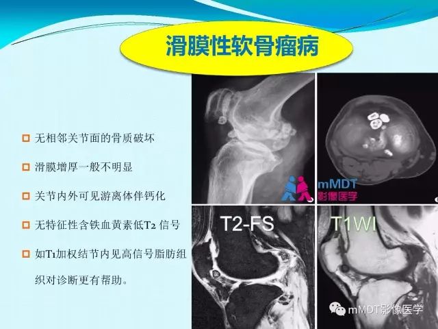 【PPT】膝关节色素沉着绒毛结节性滑膜炎影像表现PVNS