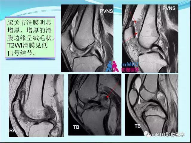 【PPT】膝关节色素沉着绒毛结节性滑膜炎影像表现PVNS
