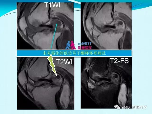 【PPT】膝关节色素沉着绒毛结节性滑膜炎影像表现PVNS