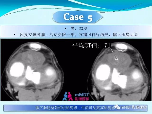 【PPT】膝关节色素沉着绒毛结节性滑膜炎影像表现PVNS