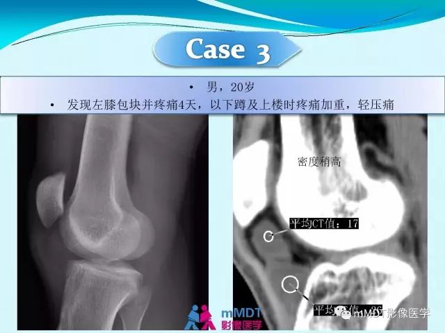 【PPT】膝关节色素沉着绒毛结节性滑膜炎影像表现PVNS