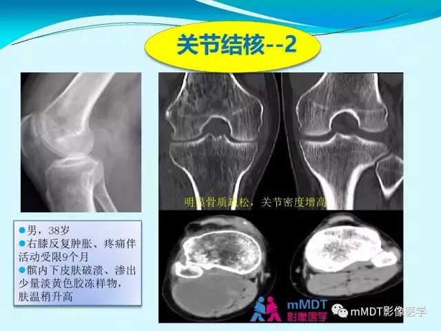 【PPT】膝关节色素沉着绒毛结节性滑膜炎影像表现PVNS